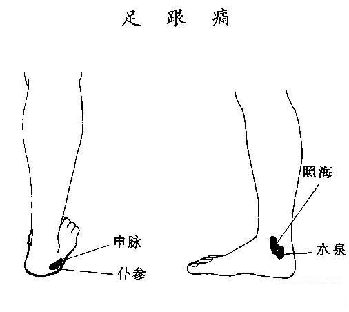 刮痧治疗足跟痛